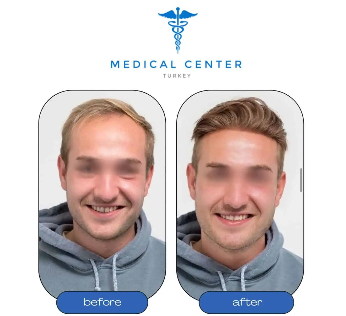 Hair transplant before and after Istanbul — natural hairline result patient 2