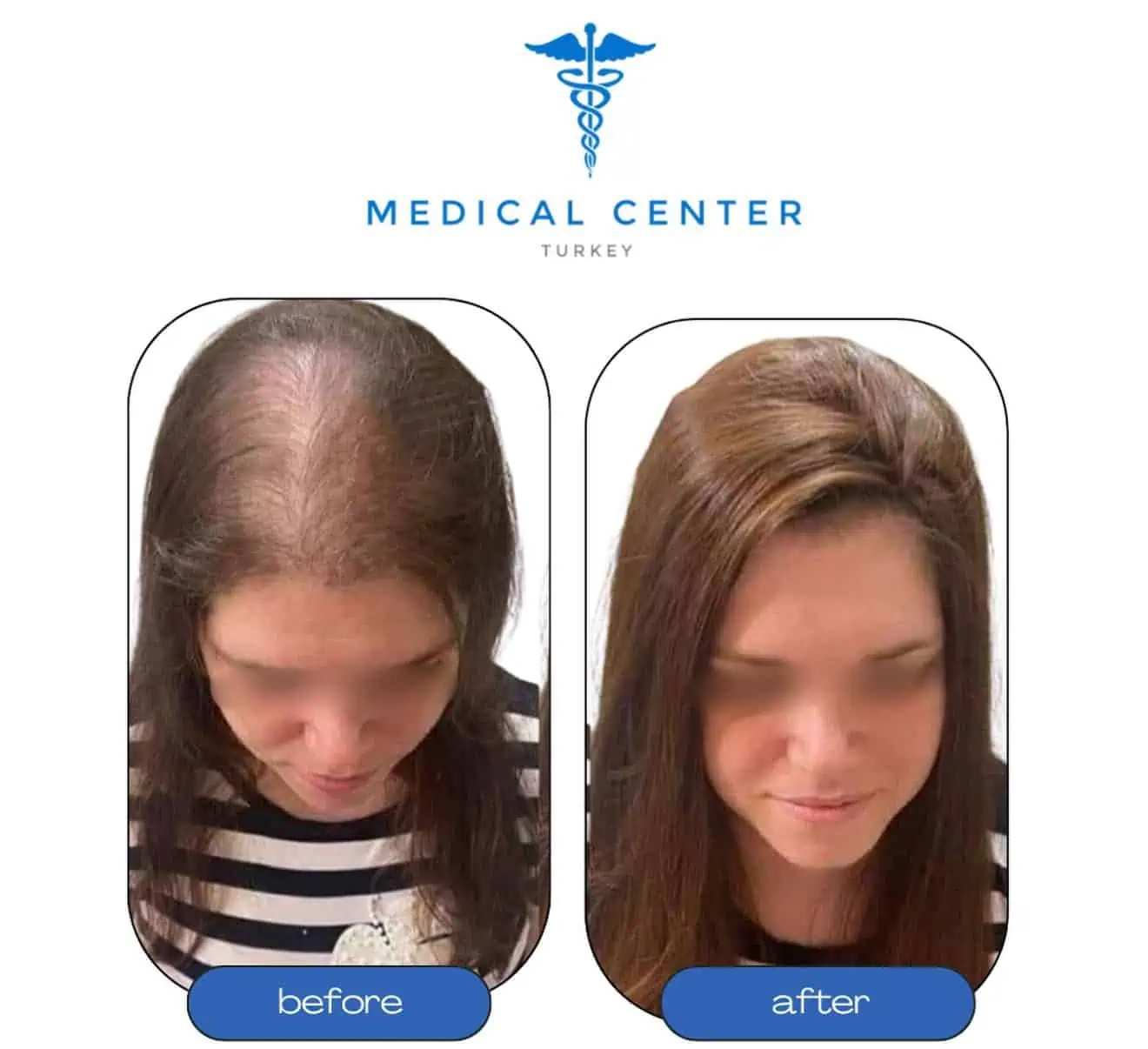 FUE hair transplant Turkey before and after — patient 3 result