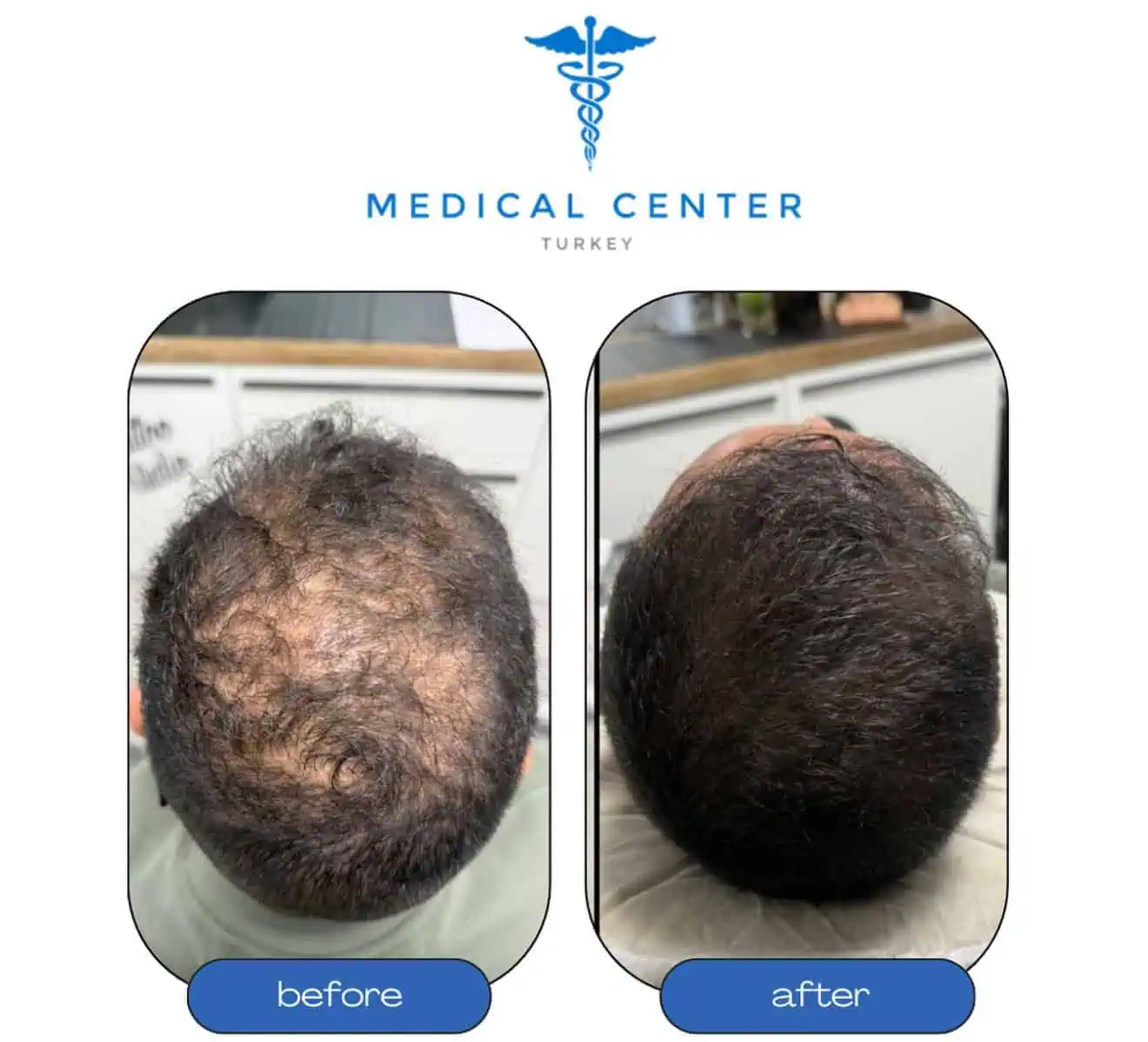 DHI hair transplant Turkey before and after — patient 4 result