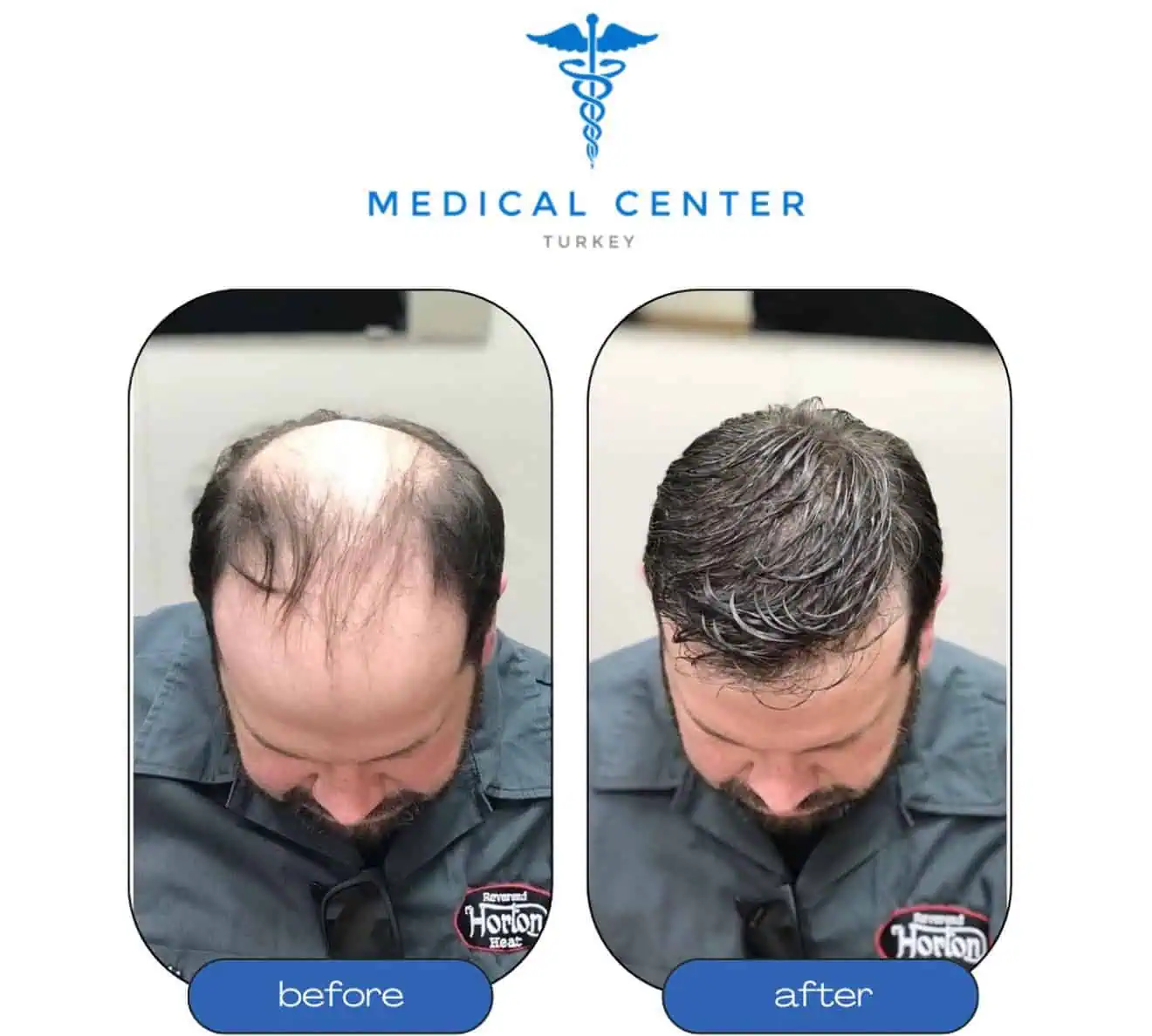 Hair transplant Turkey result — patient 5 before and after Medical Center Turkey
