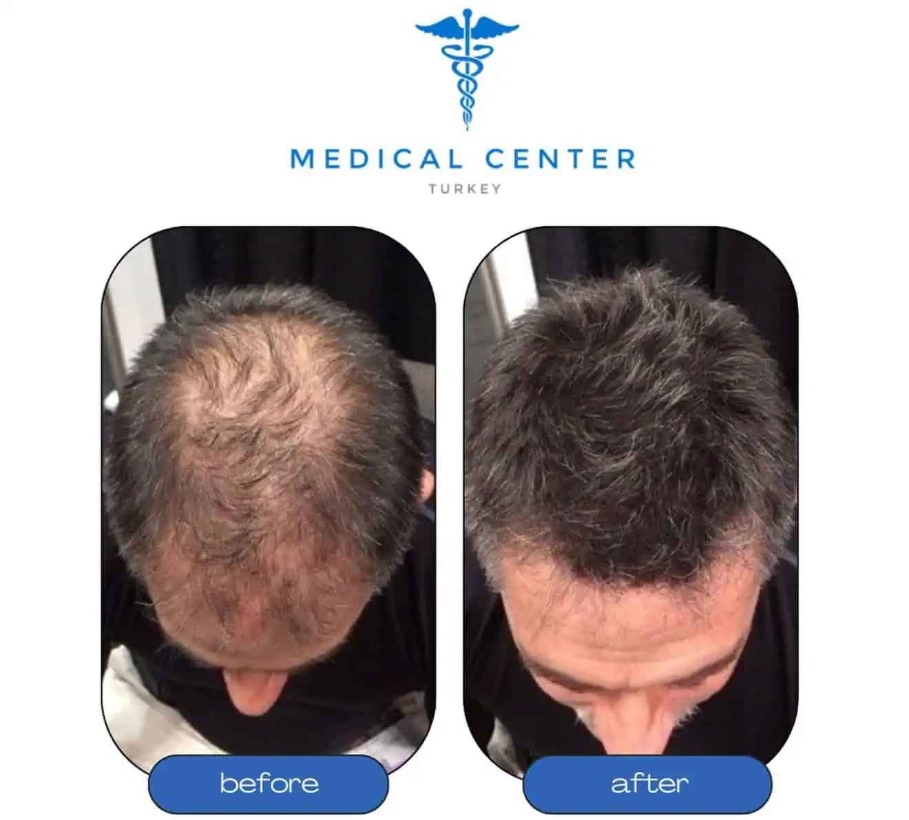 Hair transplant Istanbul before and after — patient 6 natural growth result
