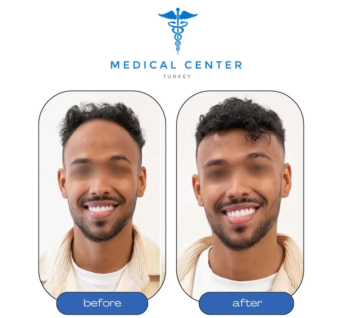 Best hair transplant Turkey before and after — patient 8 result