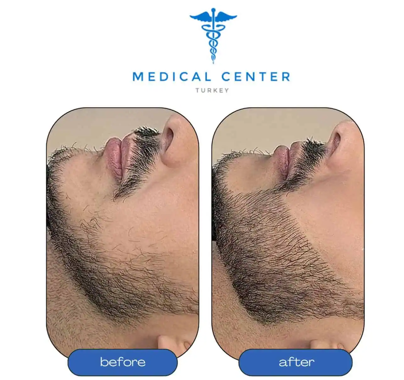 Hair transplant Turkey packages before and after — patient 9 result