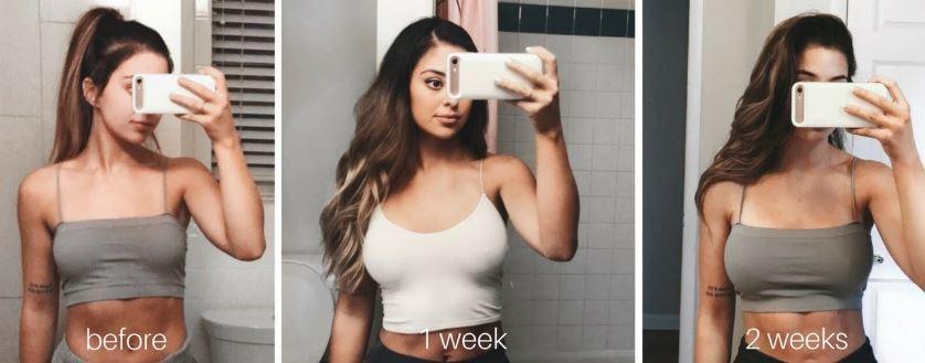 Breast Enlargement in Turkey