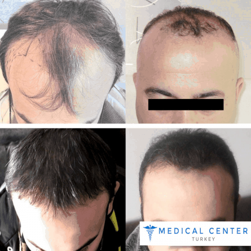 before_after_hair_transplantation