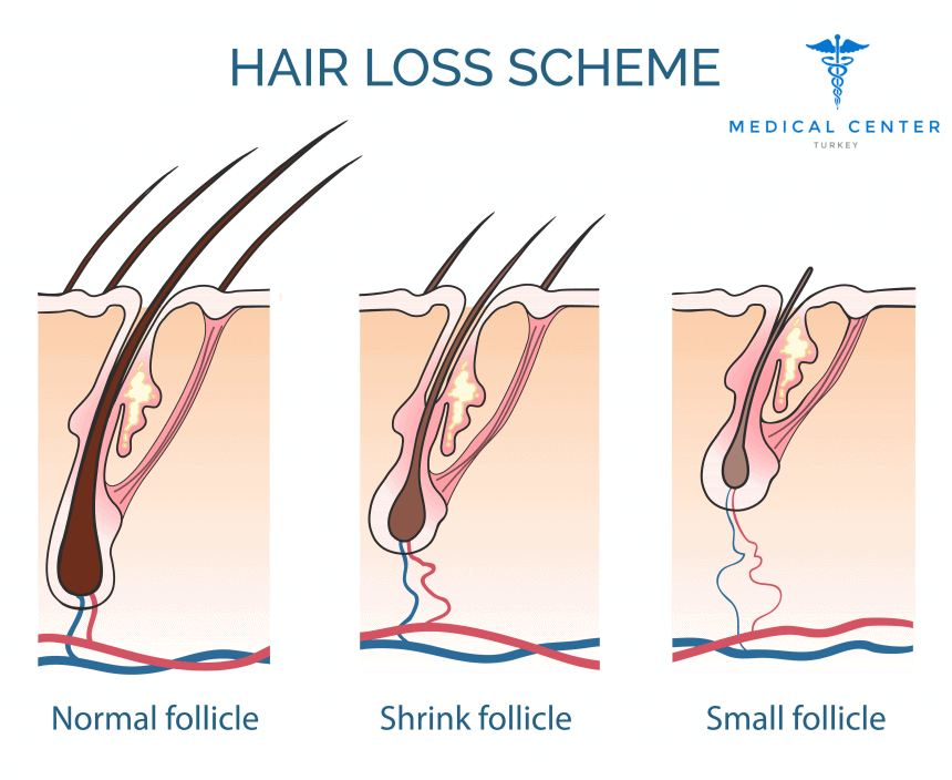 why_is_there_hair_loss