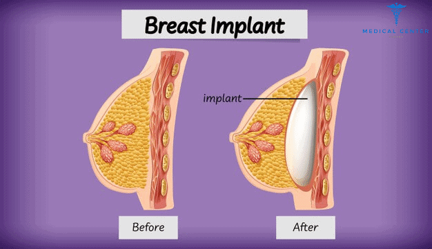 breast_augmentation_slicon