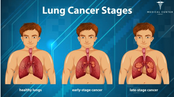 lung cancer stages