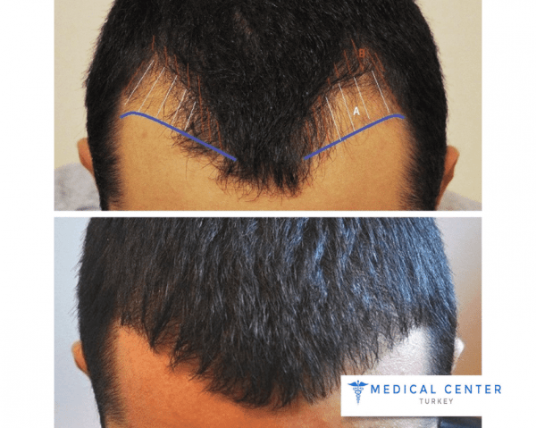 Hair Transplant Surgery Before and After Medical Center Turkey