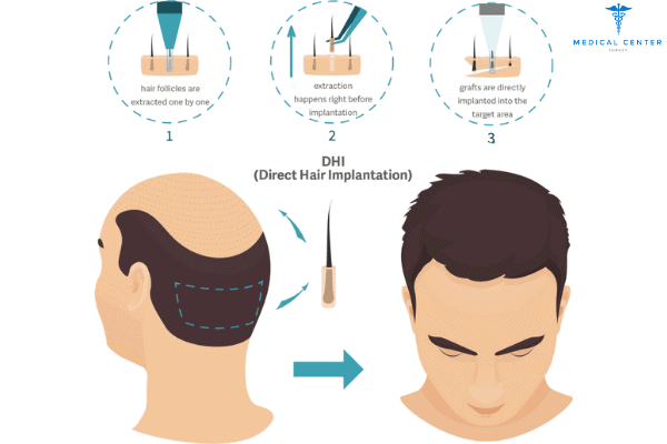 DHI vs. FUE: Hair Transplant Procedures - Medical Center Turkey
