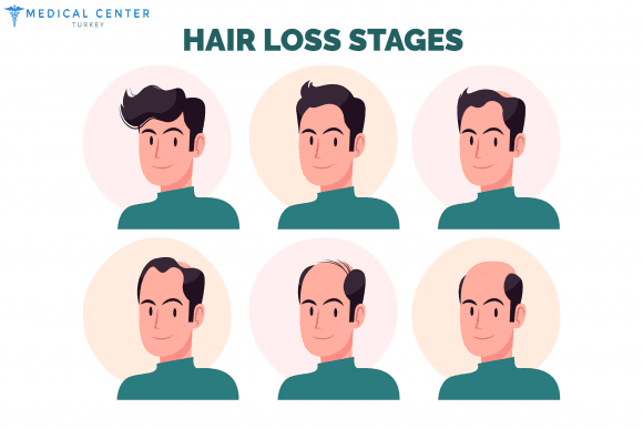 hair_lose_stages
