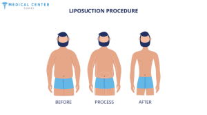 Liposuction in Turkey shape