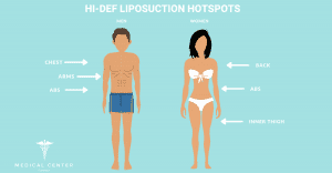 Liposuction in Turkey image