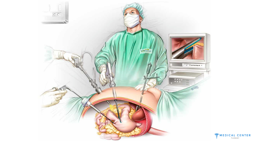 Gastric Bypass vs Gastric Sleeve: What’s Best?