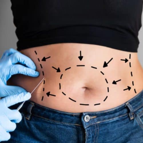 Frequently Asked Questions About Liposuction