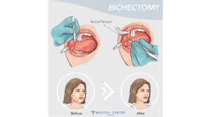 Bichectomy Surgery Cost in Turkey