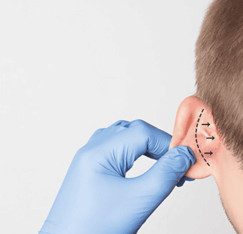 Ear Correction in Turkey Ear Correction in Turkey