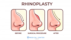 How Long Is the Rhinoplasty Recovery Time?