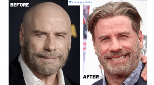 John Travolta's Hair Transplantation