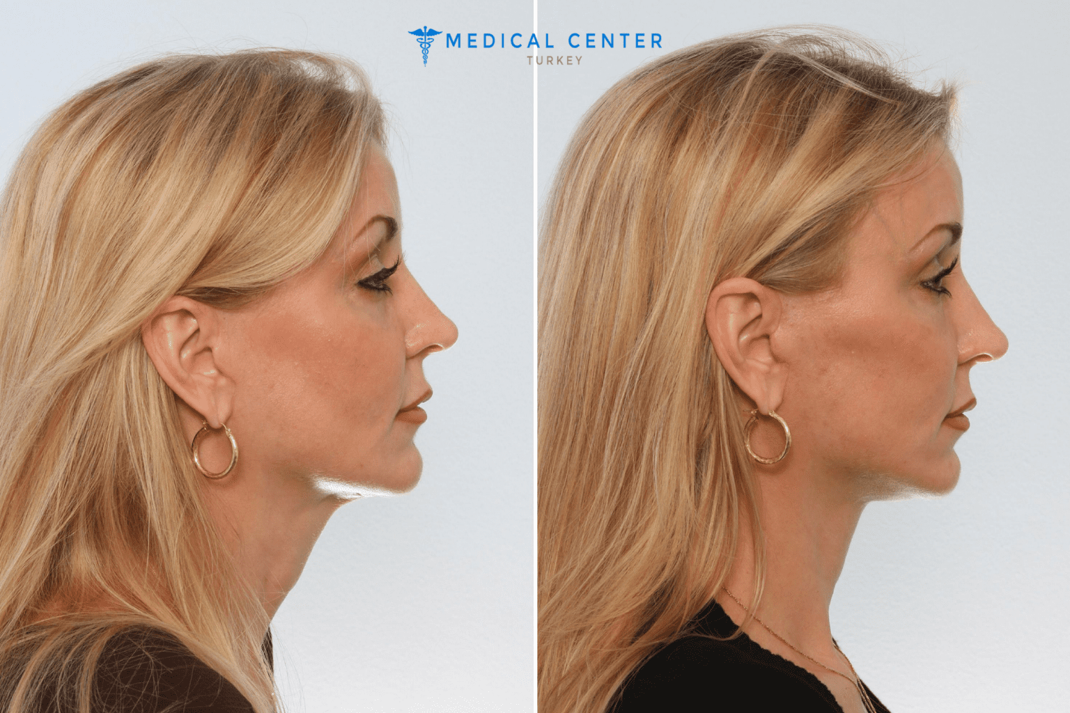 Neck Lift Surgery in Turkey Medical Center Turkey