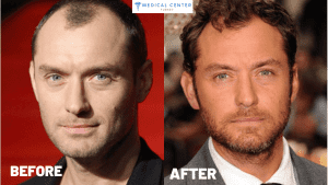 Jude Law's Hair Transplantation