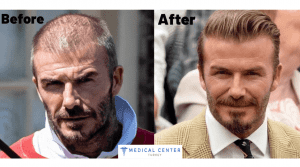 David Beckham's Hair Transplantation
