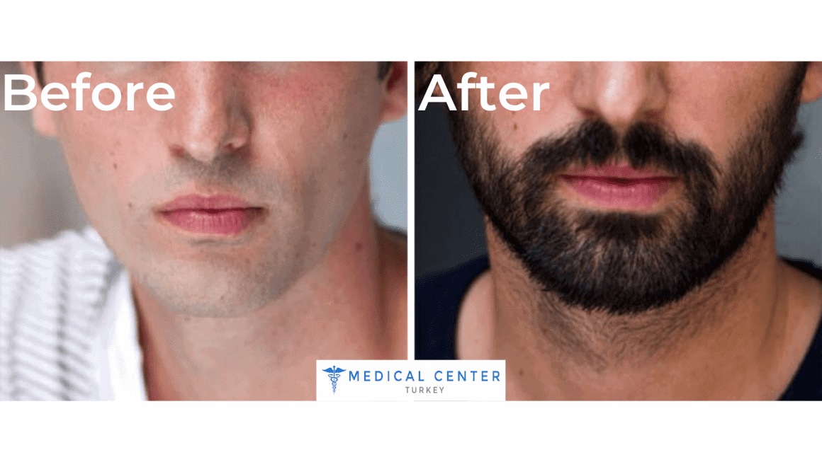 Beard Transplant Cost Turkey MCT
