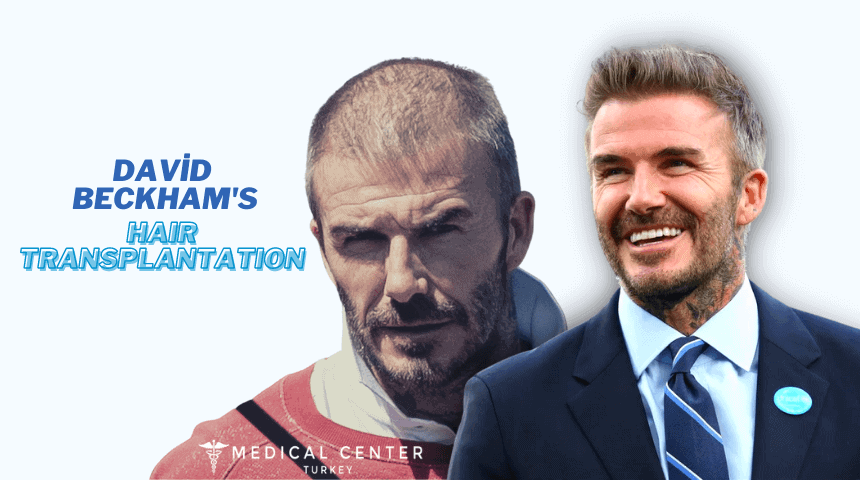 David Beckham's Hair Transplantation