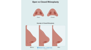 What to Do Before Rhinoplasty Surgery