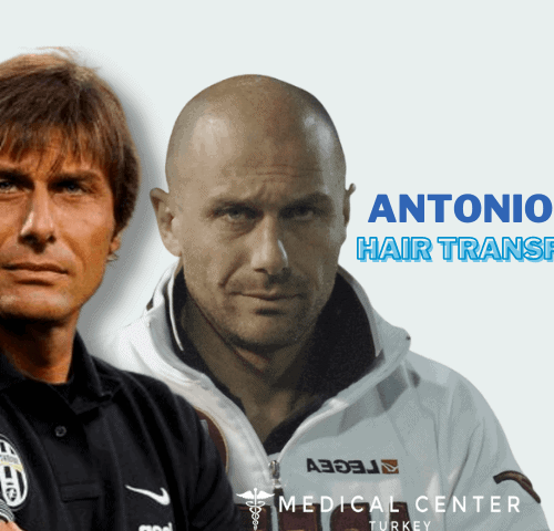 Antonio Conte's Hair Transplantation