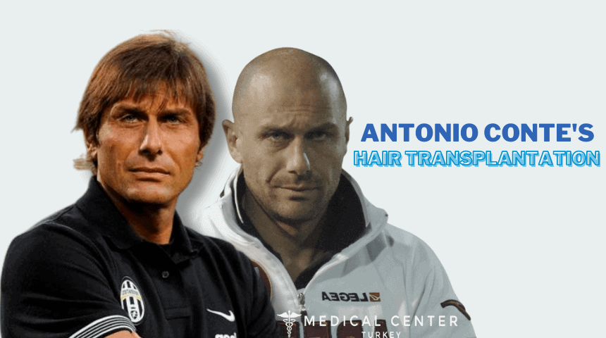 Antonio Conte's Hair Transplantation