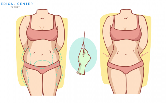 A Complete Guide to Liposuction for Women