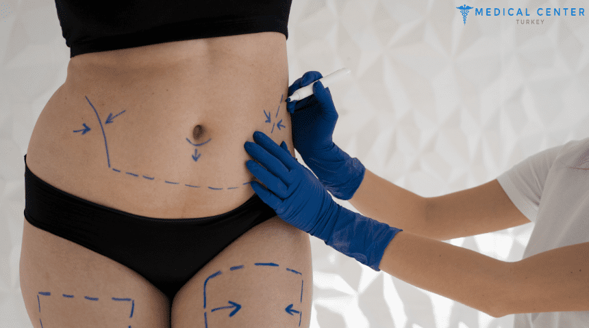 Can Liposuction Help Me Lose Weight?