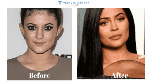 The Secret of Kylie Jenner's Lips