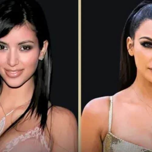 Kim Kardashian's Rhinoplasty Surgery