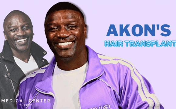 Akon's Hair Transplantation