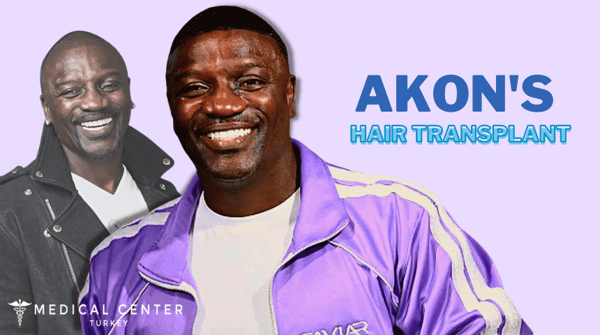 Akon's Hair Transplantation