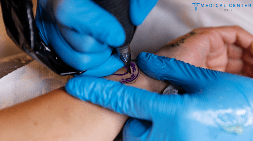 Tattoo Removal In Turkey Cost