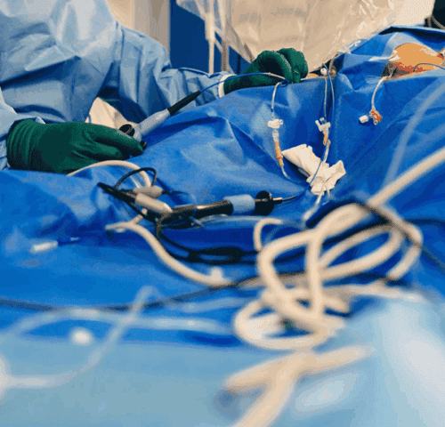 Radiofrequency Ablation in Turkey Radiofrequency Ablation in Turkey