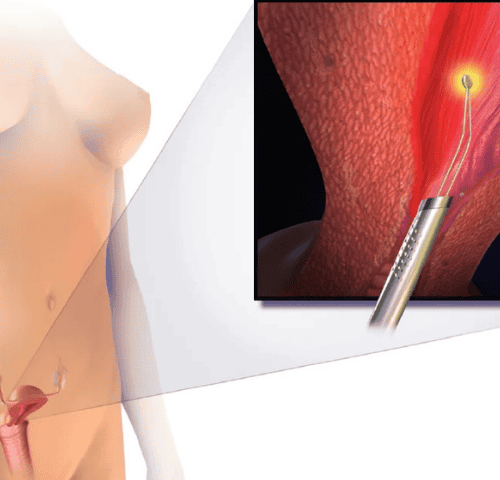 Hysterectomy in Turkey