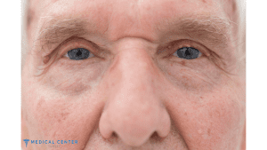 Frequently Asked Questions About Blepharoplasty