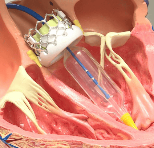 Trans Aortic Valve Replacement Surgery in Turkey Trans Aortic Valve Replacement Surgery in Turkey