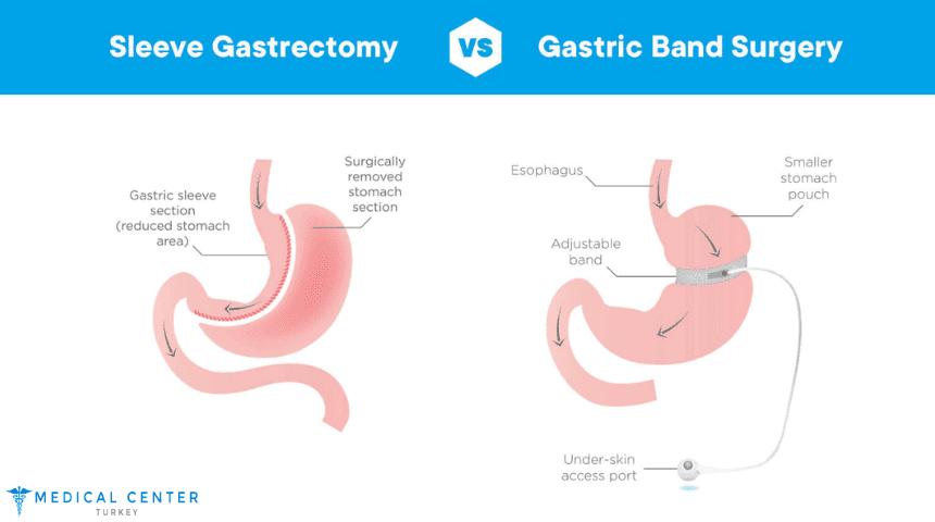 Gastric Band vs Gastric Sleeve