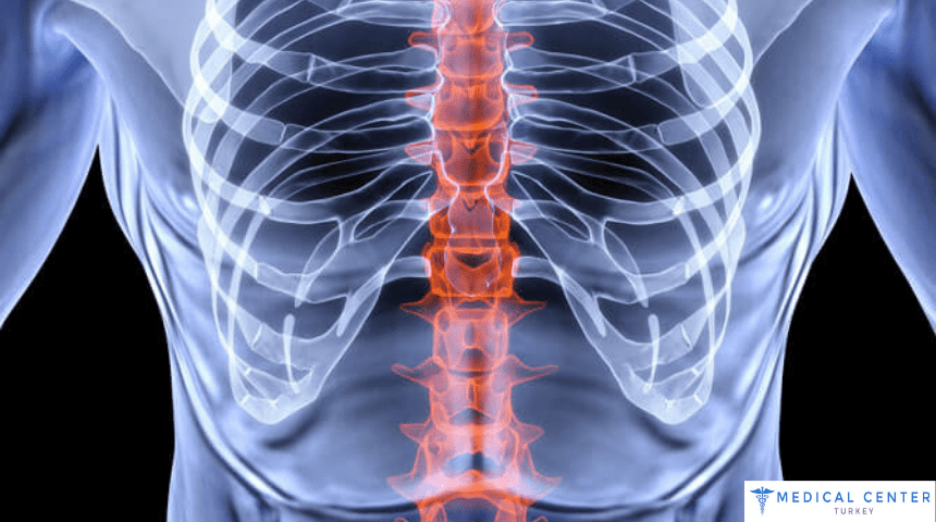 Spinal Fusion Cost in Turkey