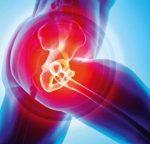 Hip Replacement in Turkey