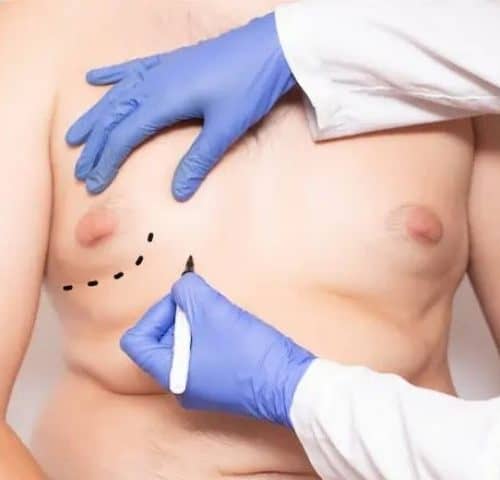 Gynecomastia Surgery in Turkey Gynecomastia Surgery in Turkey