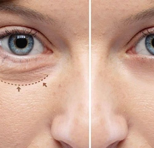 Frequently Asked Questions About Blepharoplasty