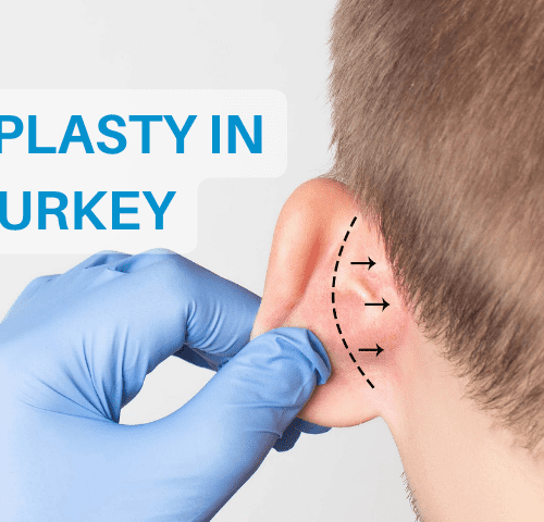 Otoplasty in Turkey