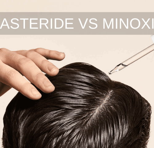 Finasteride vs Minoxidil