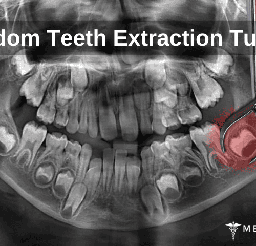 Wisdom Teeth Extraction Turkey